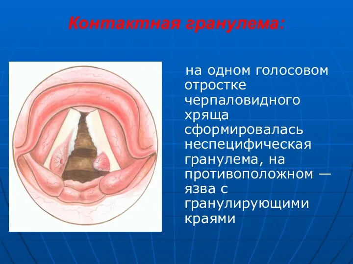 Контактная гранулема: на одном голосовом отростке черпаловидного хряща сформировалась неспецифическая