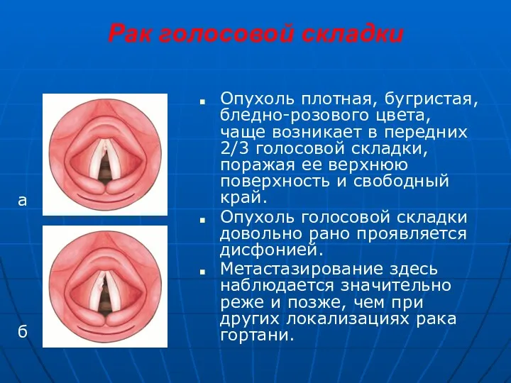 Рак голосовой складки Опухоль плотная, бугристая, бледно-розового цвета, чаще возникает