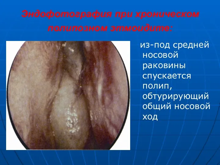 Эндофотография при хроническом полипозном этмоидите: из-под средней носовой раковины спускается полип, обтурирующий общий носовой ход