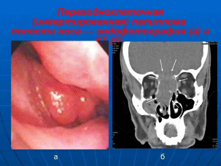Переходноклеточная (инвертированная) папиллома полости носа — эндофотография (а) и КТ (б) а б