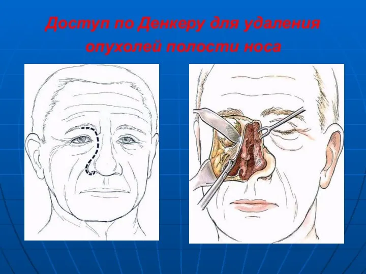 Доступ по Денкеру для удаления опухолей полости носа