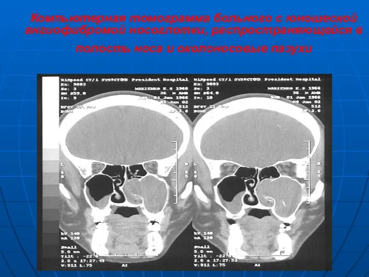 Компьютерная томограмма больного с юношеской ангиофибромой носоглотки, распространяющейся в полость носа и околоносовые пазухи
