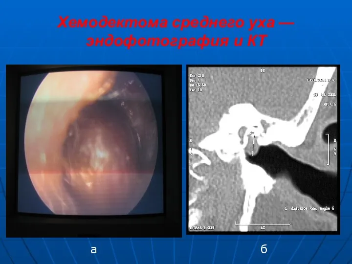 Хемодектома среднего уха — эндофотография и КТ а б