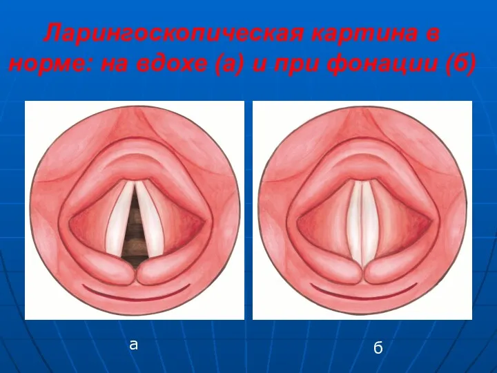 Ларингоскопическая картина в норме: на вдохе (а) и при фонации (б) б а