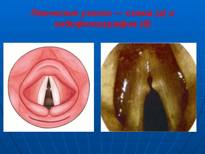 Певческие узелки — схема (а) и эндофотография (б)