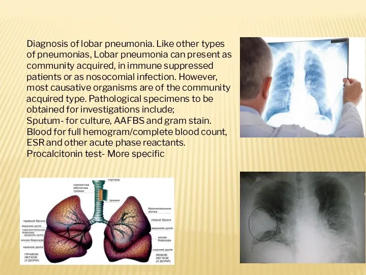 Diagnosis of lobar pneumonia. Like other types of pneumonias, Lobar