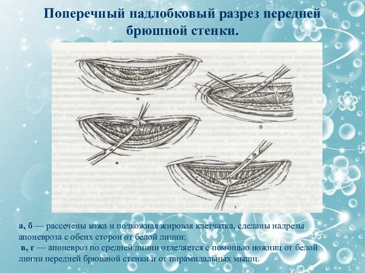 Поперечный надлобковый разрез передней брюшной стенки. а, б — рассечены