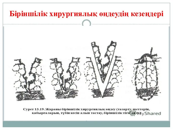 Біріншілік хирургиялық өңдеудің кезеңдері