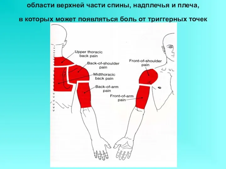 области верхней части спины, надплечья и плеча, в которых может появляться боль от триггерных точек