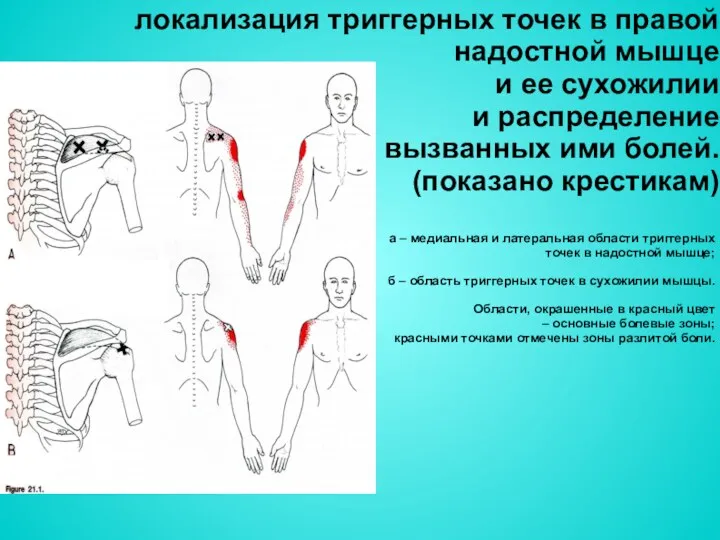 локализация триггерных точек в правой надостной мышце и ее сухожилии и распределение вызванных