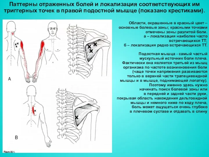 Паттерны отраженных болей и локализация соответствующих им триггерных точек в правой подостной мышце