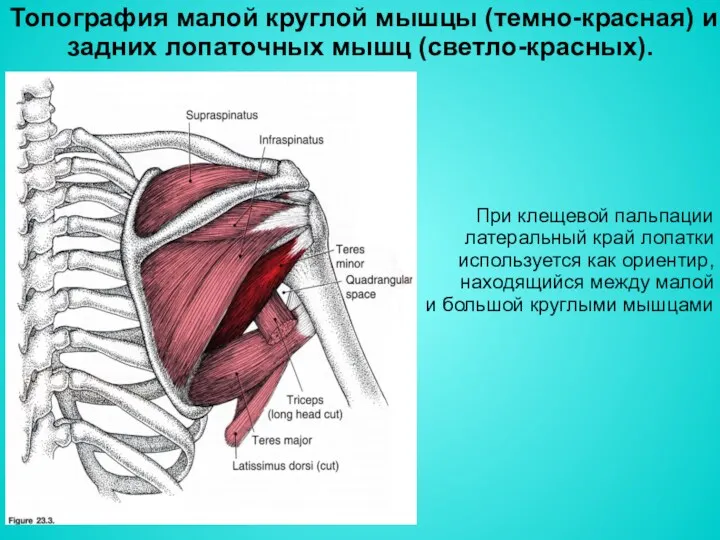 Топография малой круглой мышцы (темно-красная) и задних лопаточных мышц (светло-красных). При клещевой пальпации