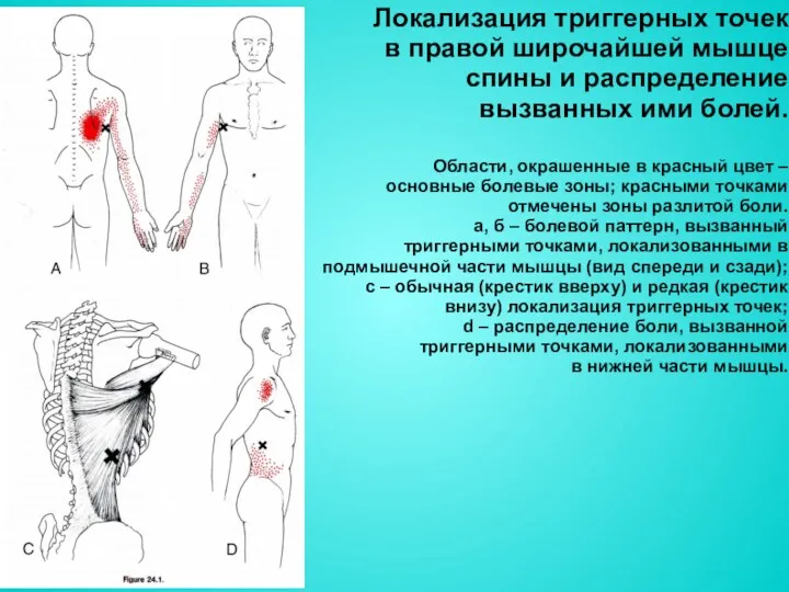 Локализация триггерных точек в правой широчайшей мышце спины и распределение вызванных ими болей.