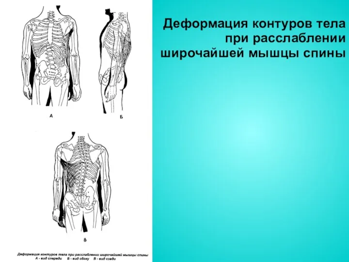 Деформация контуров тела при расслаблении широчайшей мышцы спины