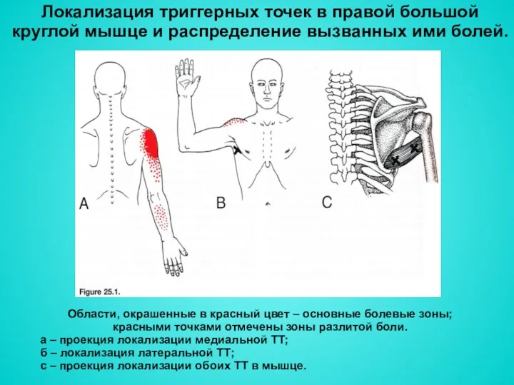 Локализация триггерных точек в правой большой круглой мышце и распределение вызванных ими болей.