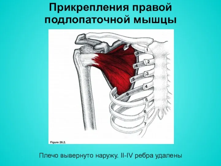 Прикрепления правой подлопаточной мышцы Плечо вывернуто наружу. II-IV ребра удалены