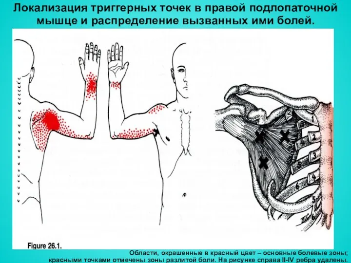 Локализация триггерных точек в правой подлопаточной мышце и распределение вызванных ими болей. Области,