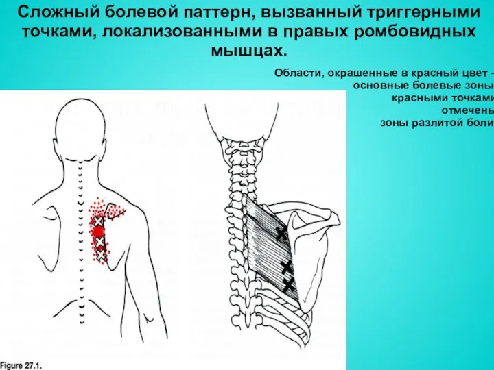 Сложный болевой паттерн, вызванный триггерными точками, локализованными в правых ромбовидных мышцах. Области, окрашенные