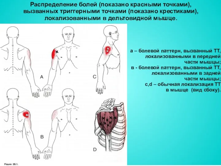 Распределение болей (показано красными точками), вызванных триггерными точками (показано крестиками), локализованными в дельтовидной