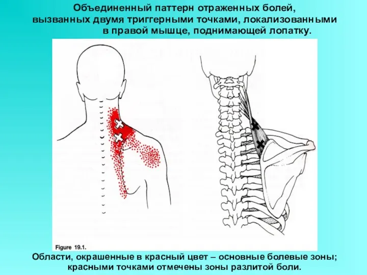 Объединенный паттерн отраженных болей, вызванных двумя триггерными точками, локализованными в правой мышце, поднимающей