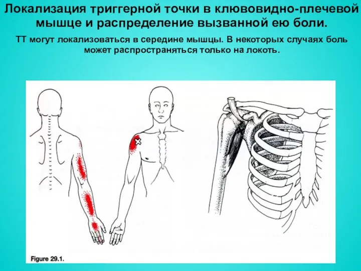 Локализация триггерной точки в клювовидно-плечевой мышце и распределение вызванной ею боли. ТТ могут