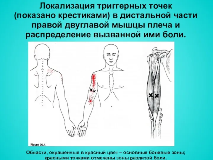 Локализация триггерных точек (показано крестиками) в дистальной части правой двуглавой мышцы плеча и