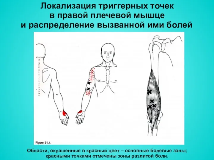 Локализация триггерных точек в правой плечевой мышце и распределение вызванной ими болей. Области,