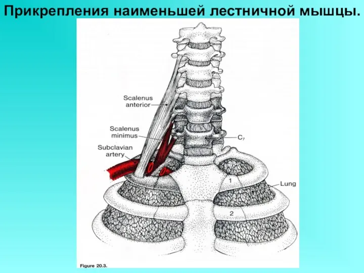 Прикрепления наименьшей лестничной мышцы. Обратите внимание на уровень, до которого поднимается угол плевры.