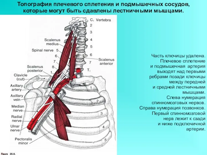 Топография плечевого сплетения и подмышечных сосудов, которые могут быть сдавлены лестничными мышцами. Часть