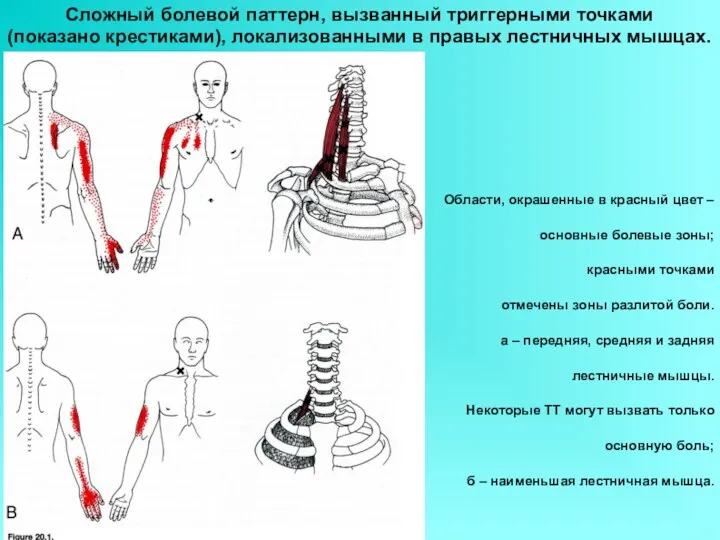 Сложный болевой паттерн, вызванный триггерными точками (показано крестиками), локализованными в правых лестничных мышцах.
