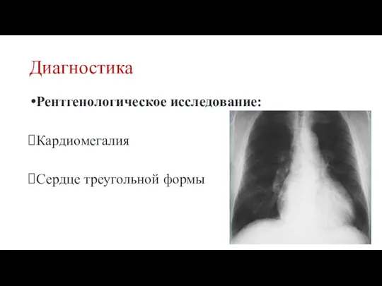 Диагностика Рентгенологическое исследование: Кардиомегалия Сердце треугольной формы