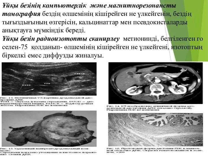 Ұйқы безінің компьютерлік және магнитнорезонансты томография бездің өлшемінің кішірейген не