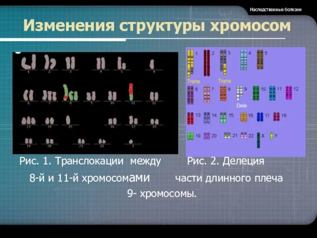 Изменения структуры хромосом Рис. 1. Транслокации между Рис. 2. Делеция 8-й и 11-й