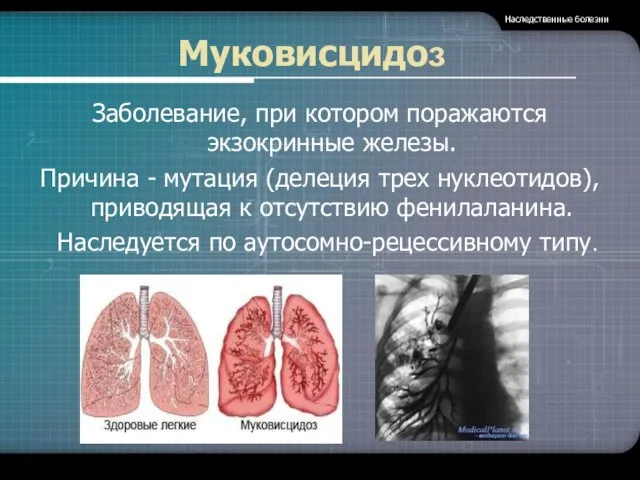 Муковисцидоз Заболевание, при котором поражаются экзокринные железы. Причина - мутация (делеция трех нуклеотидов),