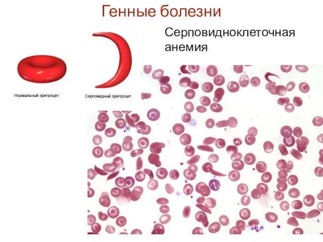 Генные болезни Серповидноклеточная анемия
