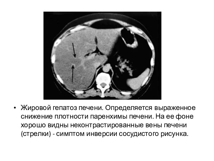 Жировой гепатоз печени. Определяется выраженное снижение плотности паренхимы печени. На