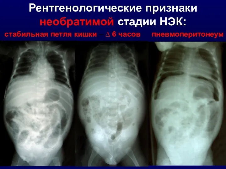 Рентгенологические признаки необратимой стадии НЭК: стабильная петля кишки – ∆ 6 часов пневмоперитонеум