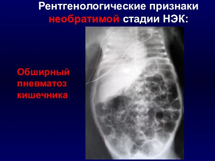 Обширный пневматоз кишечника Рентгенологические признаки необратимой стадии НЭК: