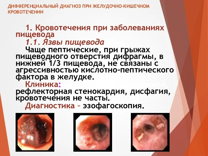 ДИФФЕРЕНЦИАЛЬНЫЙ ДИАГНОЗ ПРИ ЖЕЛУДОЧНО-КИШЕЧНОМ КРОВОТЕЧЕНИИ 1. Кровотечения при заболеваниях пищевода