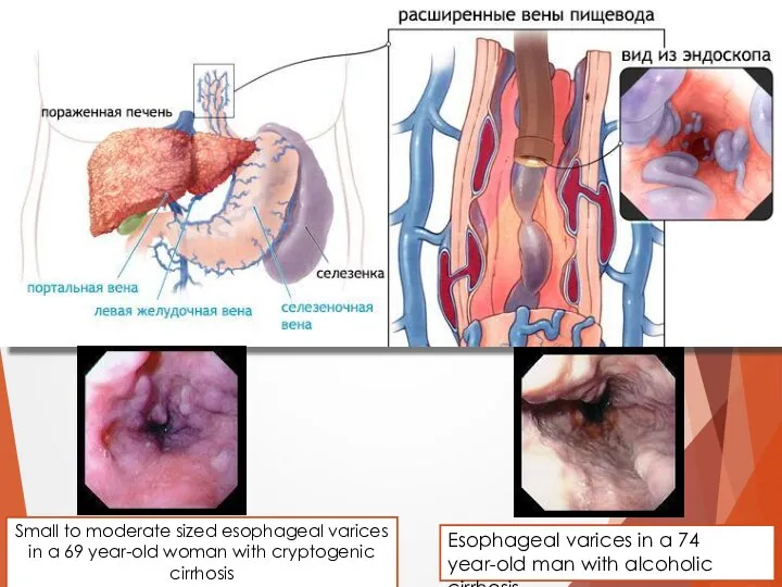 Small to moderate sized esophageal varices in a 69 year-old