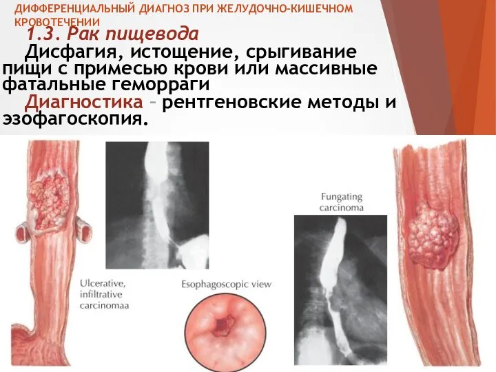 ДИФФЕРЕНЦИАЛЬНЫЙ ДИАГНОЗ ПРИ ЖЕЛУДОЧНО-КИШЕЧНОМ КРОВОТЕЧЕНИИ 1.3. Рак пищевода Дисфагия, истощение,