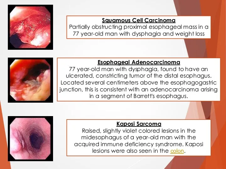 Squamous Cell Carcinoma Partially obstructing proximal esophageal mass in a