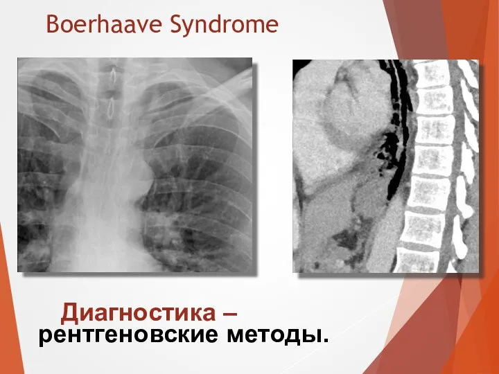 Boerhaave Syndrome Диагностика – рентгеновские методы.