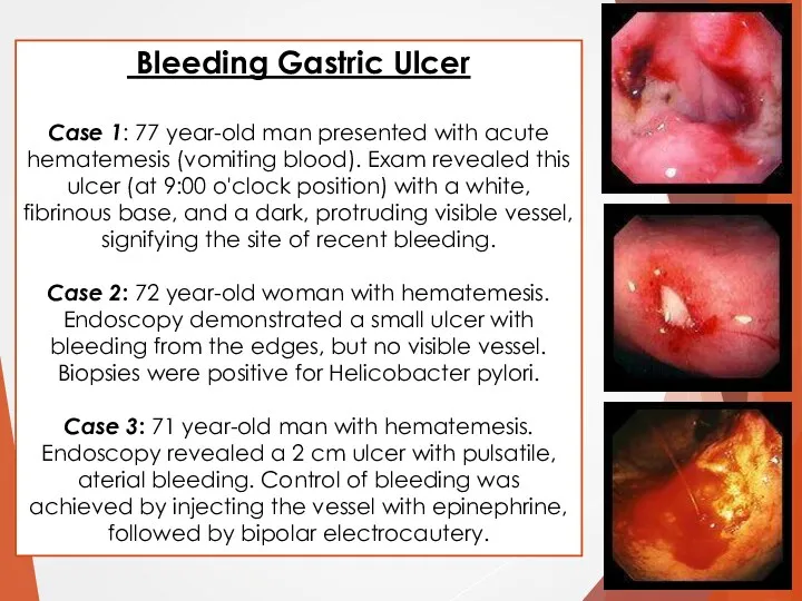 Bleeding Gastric Ulcer Case 1: 77 year-old man presented with