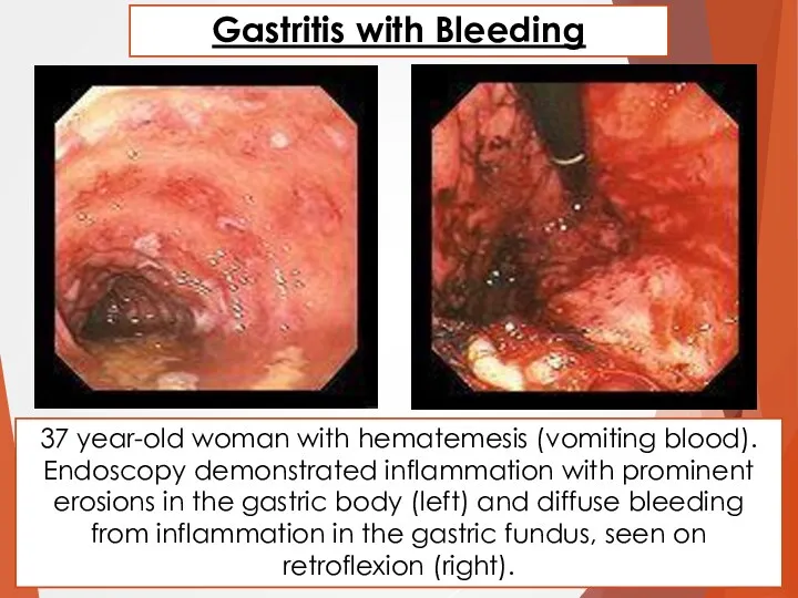 37 year-old woman with hematemesis (vomiting blood). Endoscopy demonstrated inflammation