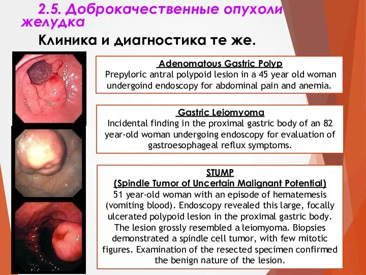 2.5. Доброкачественные опухоли желудка Клиника и диагностика те же. Adenomatous