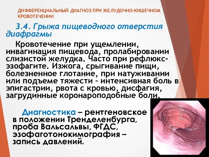 ДИФФЕРЕНЦИАЛЬНЫЙ ДИАГНОЗ ПРИ ЖЕЛУДОЧНО-КИШЕЧНОМ КРОВОТЕЧЕНИИ 3.4. Грыжа пищеводного отверстия диафрагмы