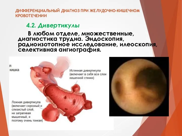 ДИФФЕРЕНЦИАЛЬНЫЙ ДИАГНОЗ ПРИ ЖЕЛУДОЧНО-КИШЕЧНОМ КРОВОТЕЧЕНИИ 4.2. Дивертикулы В любом отделе,