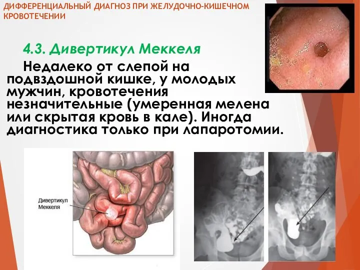 ДИФФЕРЕНЦИАЛЬНЫЙ ДИАГНОЗ ПРИ ЖЕЛУДОЧНО-КИШЕЧНОМ КРОВОТЕЧЕНИИ 4.3. Дивертикул Меккеля Недалеко от