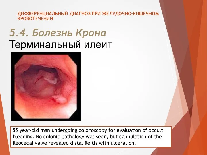 5.4. Болезнь Крона ДИФФЕРЕНЦИАЛЬНЫЙ ДИАГНОЗ ПРИ ЖЕЛУДОЧНО-КИШЕЧНОМ КРОВОТЕЧЕНИИ 55 year-old